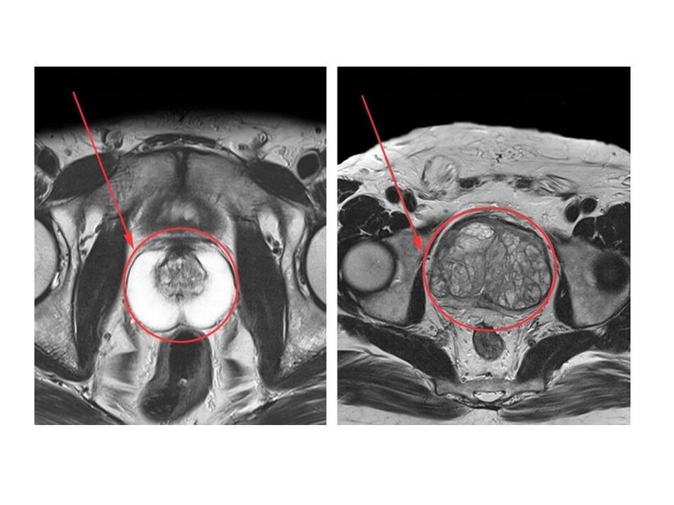 Comparación dunha próstata sa (esquerda) e inflamada (dereita) en imaxes de resonancia magnética